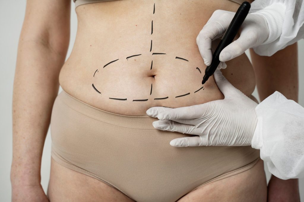 Abdominoplastie